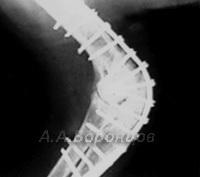 Артродез с использованием накостной пластины, шурупов, спиц Киршнера и аппарата Илизарова