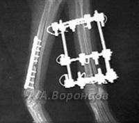 Поперечные переломы со смещением лучевой и локтевой костей левой и правой конечности
