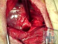 Наложена лигатура на артериальный проток