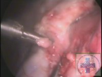 Торакоскопия диагностика открытого артериального протока (боталлов проток) у собаки