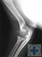 Дисплазия локтевого сустава у собаки. Дисконгруэнтность. Определяется недостаточный рост лучевой кости.