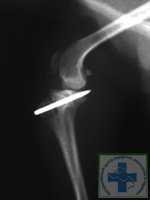 Рентгенограмма после транспозиции бугристости большеберцовой кости при медиальном вывихе