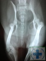 Вывих коленной чашечки 4 степени с деформацией бедренной и боьшеберцовой костей. Рентгенограмма.
