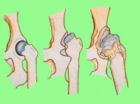 Дисплазия тазобедренных суставов: как лечит остеопатия врожденную патологию